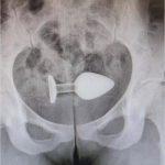 Del placer al quirófano: los objetos atrapados en el recto que terminaron en perforaciones, sangre y colostomías
