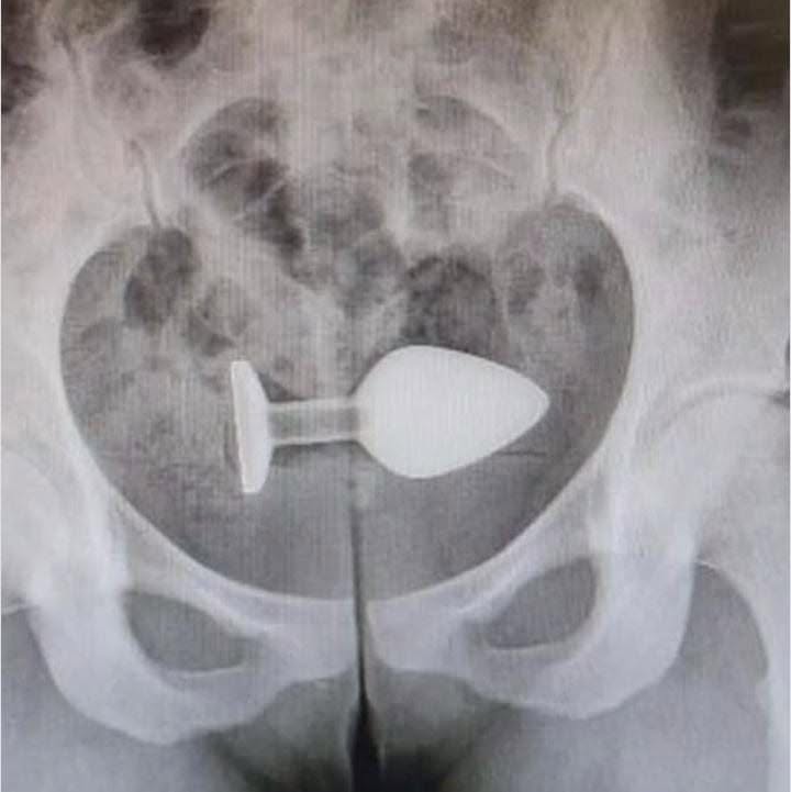 Del placer al quirófano: los objetos atrapados en el recto que terminaron en perforaciones, sangre y colostomías