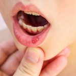 Gonorrea en la garganta, úlceras y cáncer: los peligros del sexo oral sin preservativo que pueden convertir una noche de placer en una pesadilla