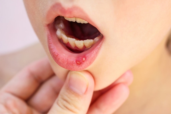 Gonorrea en la garganta, úlceras y cáncer: los peligros del sexo oral sin preservativo que pueden convertir una noche de placer en una pesadilla